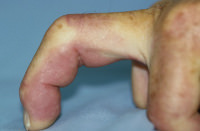 Foto von Dr. Gabl: Ein gekr&uml;mmter Finger